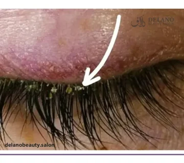 عوارض کاشت مژه دائم