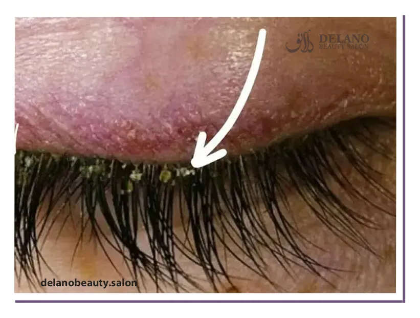 عوارض کاشت مژه دائم