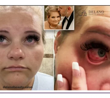 عوارض کاشت مژه موقت