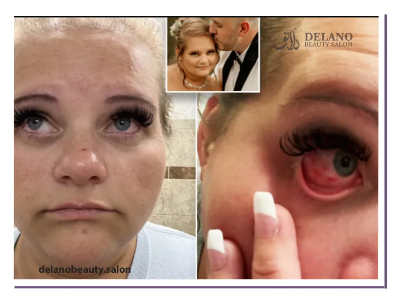 عوارض کاشت مژه موقت