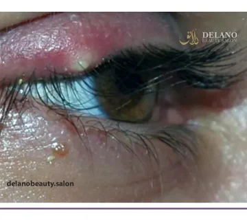 عوارض لیفت مژه